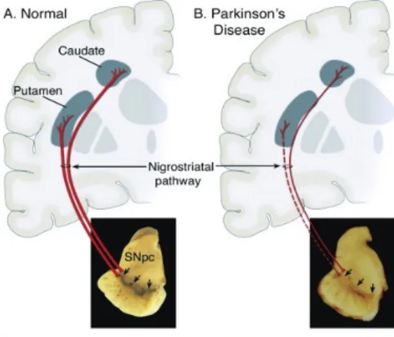 Figure  2: Schéma illustrant la dégénérescence des neurones dopaminergiques dans la maladie  de  Parkinson  qui  est  à  l’origine  des  troubles  moteurs 34 