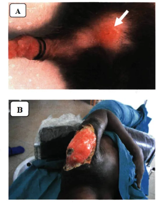 Fig. 1.11 : Signes cliniques au stade d'ulcération : (A) Ulcération chez la souris; (B) Vaste  nécrose du galbe de l'épaule chez l'humain (Sources : (A) Germain Mabèrou Houngbédji  (B) CDT/Allada-Bénin)