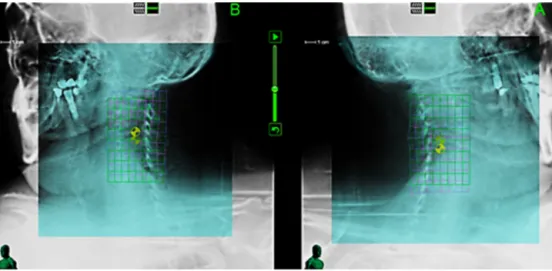 Fig. 1. XSight spine tracking system, showing misalignment between the orthogonal digitally reconstructed radiography (DRR) and the image-of-the-day grids.