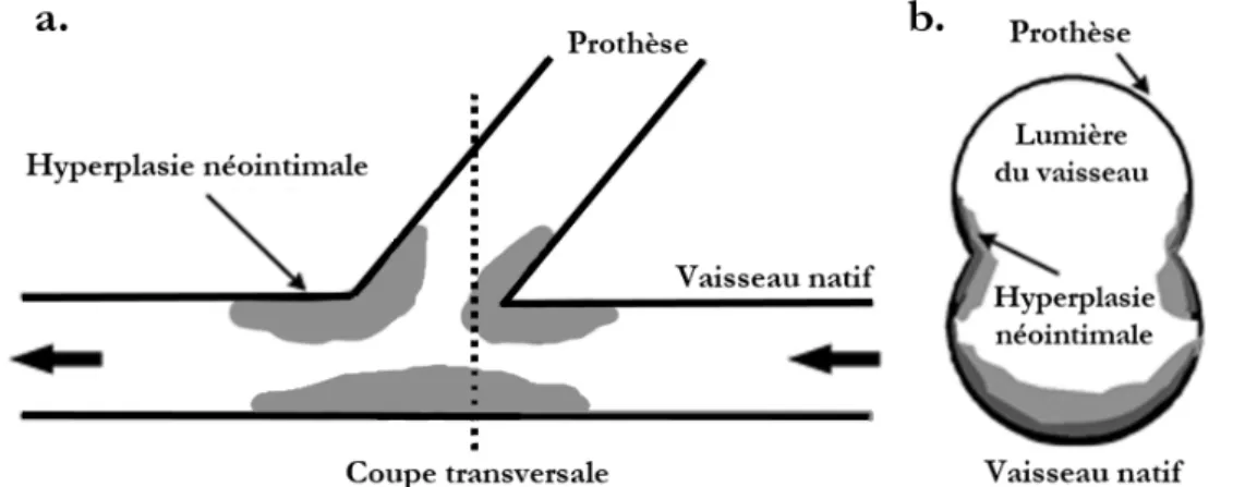 Figure 1 - 4. Représentation de l’hyperplasie néointimale à l’anastomose vaisseau natif- natif-prothèse (adaptée de [20])  a