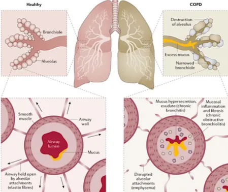 Figure 1.1. : Caractéristiques pathophysiologiques de la MPOC/COPD. 