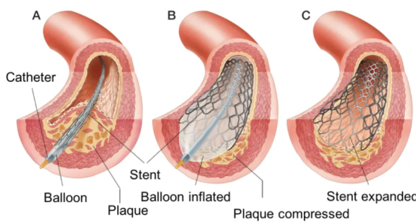 Figure 1.7. Stenting procedure. 18