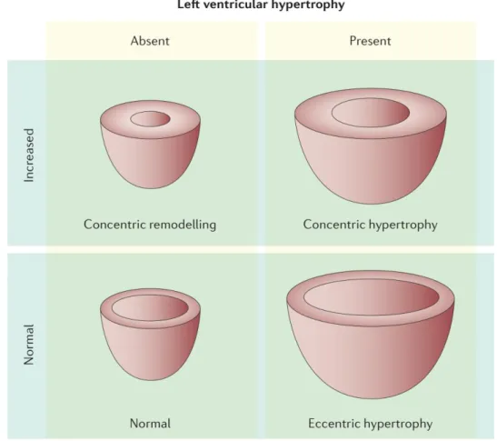Figure  1-4 :  différents  types  de  remodelage  ventriculaires  rencontrés  dans  la  SA