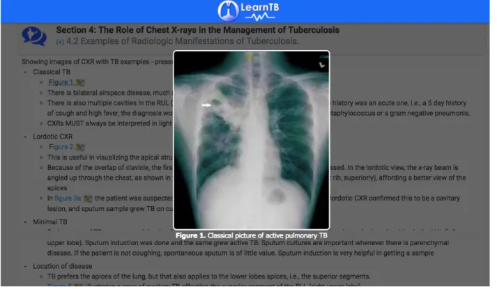 Figure 7: LearnTB application – figure of chest x-ray in Section 4 “Role of chest x-rays in the  management of tuberculosis” 