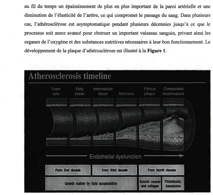 Figure 1 : Développement de la plaque d'athérosclérose. Tirée de Pepine CJ, 1998 (22) 