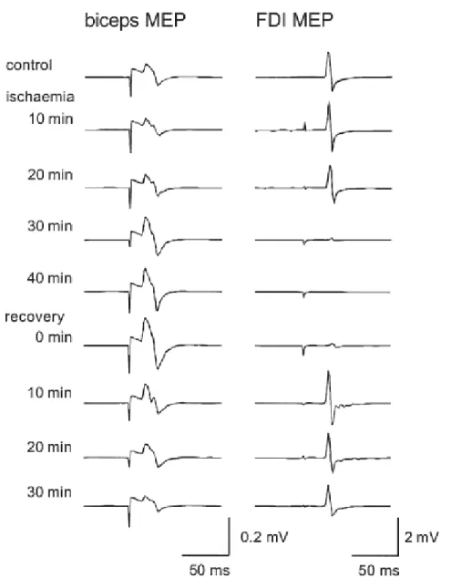 Figure 1 : Évolution de l’excitabilité corticospinale du FDI (first dorsal interosseous) et du biceps lors de  l’application d’une déafférentation ischémique transitoire au niveau de l’avant-bras