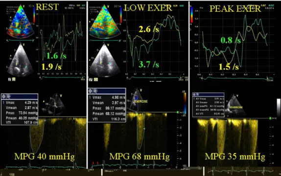 Figure 1. Quantitative exercise Doppler echocardiographic evaluation of a patient with severe asymptomatic aortic valve stenosis.