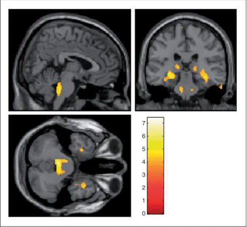 Figure 2. t-values (color-coded) of voxels where 18 FDG uptake is postively correlated with age in 19 interictal episodic migraine without aura patients (4, 28, 36)