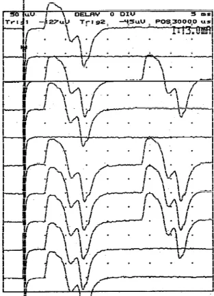 FIGURE 1. Single thenar motor unit F waves evoked by near- near-threshold stimulation in a healthy subject