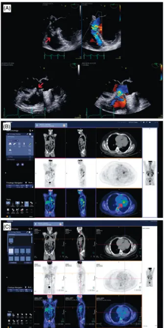 Figure 1. Perimembraneous ventricular septal defect (VSD) presenting an aneurism and abnormal thickening of the defect mar- mar-gins