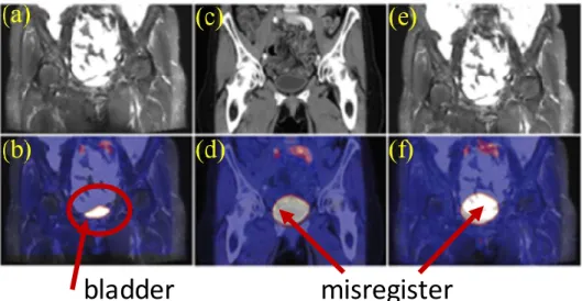 Figure 2-6. Comparison of simultaneous PET/MRI, PET/CT, and sequential PET/MRI. (a) MRI,   (b) simultaneous PET/MRI, (c) CT, (d) PET/CT, (e) MRI, and (f) sequential PET/MRI (Richard et 