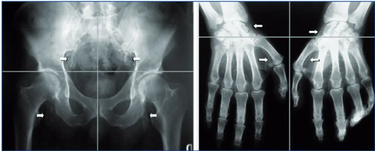 Figure 8. Plain radiography of pelvis and hands. A. Calcification score is the sum of the presence (1) or absence (0) of parallel linear calcifications in each section
