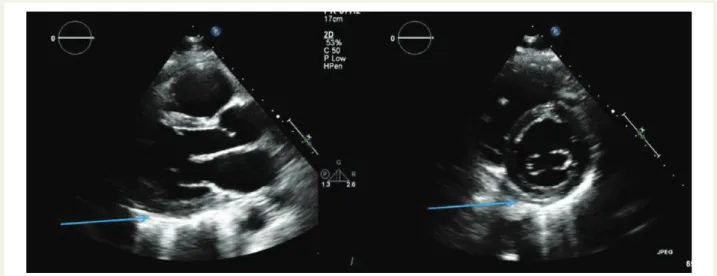 Şekil 4  Akut perikardit tanısıyla başvuran hastada ekokardiyografik inceleme. Akut perikarditi olan bu hastada sol ventrikülün  anterolateral ve inferolateral duvar komşuluğunda artmış perikart kalınlığı ve perikart effüzyonu olmamasına dikkat ediniz (okl