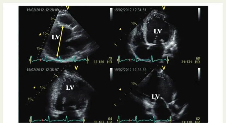 Şekil 5  Akut dispne ile gelen dilate kardiyomiyopati ve bozuk sol ventrikül sistolik işlevli hastanın ekokardiyografi incelemesi