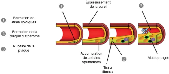 Figure 1: Processus du développement de l’athérosclérose  Figure adaptée de Ellertsen et al