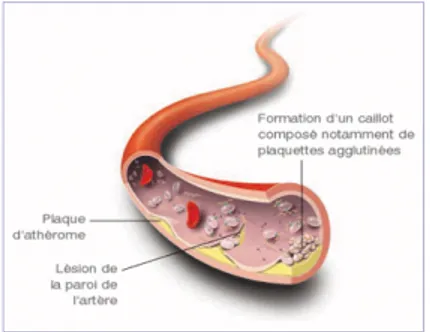Figure 1  Plaques d'athérome dans une artère. (http ://atheroscle- ://atheroscle-rose.blogspot.fr/)