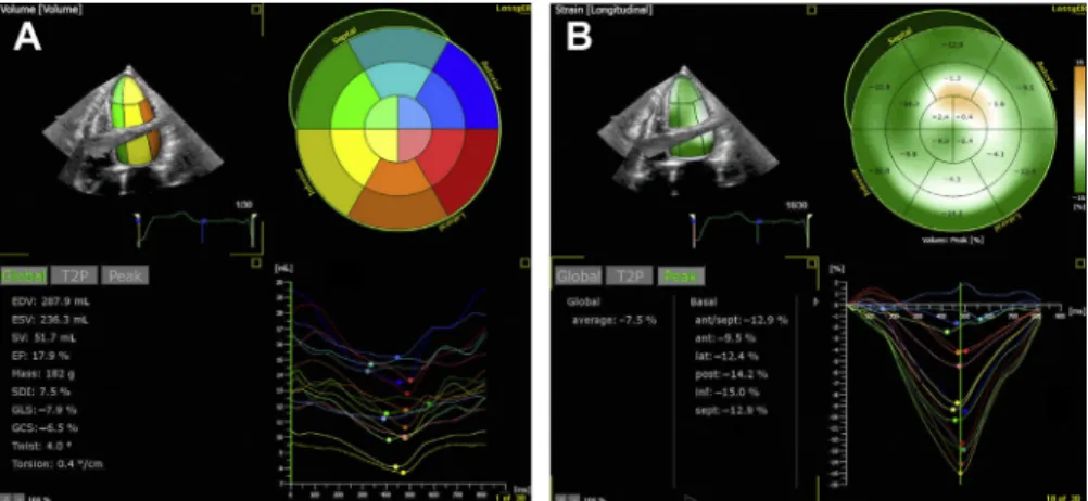 Fig. 2. Assessment of the left ventricle: (A) 3-dimensional echo-based assessment of volumes, ejection fraction, systolic dyssynchrony; (B) 3-dimensional echo-based assessment of Global Longitudinal Strain and systolic  dyssyn-chrony based on peak strain.