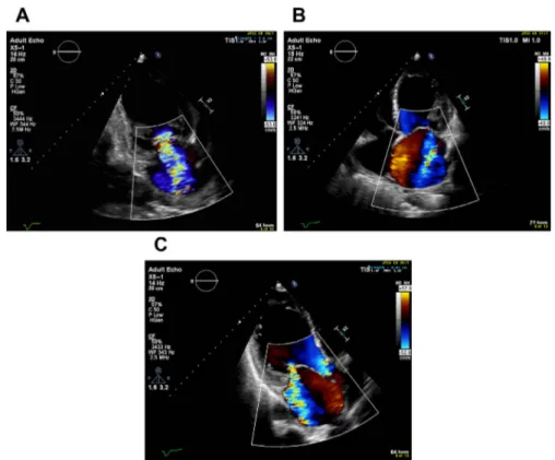 Fig. 5. Color-flow Doppler demonstrating large vena contracta in the bicommissural 2-chamber view (A) and smaller vena contracta in 4-chamber (B) and 3-chamber (apical long-axis) view (C) in ventricular-secondary MR.