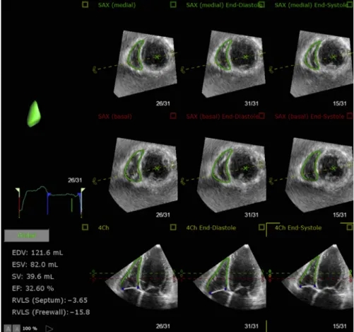 Fig. 6. Assessment of right ventricular volumes and ejection fraction using 3D transthoracic echocardiography.