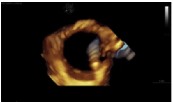 Fig. 8. Three-dimensional echocardiography image obtained with oblique rendering of the base of the heart to visualize the annuli of both atrioventricular valves