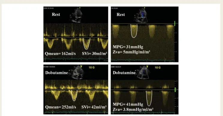 Figure 1 Doppler echocardiographic measurements in a patient with low-flow/low-gradient severe aortic stenosis