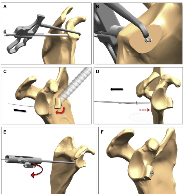 Figure 1 Arthroscopic guided Eden-Hybbinette using suture-button fixation for revision of failed Latarjet