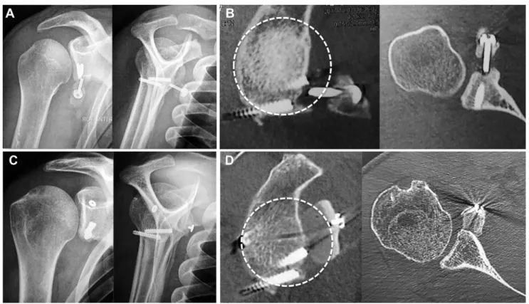Figure 2 Arthroscopic revision Eden-Hybbinette for failed Latarjet in a 24-year-old rugby player with recurrent dislocations, coracoid bone block nonunion, and broken hardware