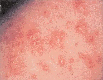 Fig. 1. Eczéma de contact allergique à la colophane.