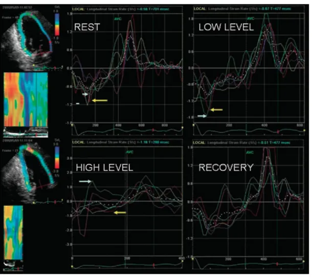 Figure 3. Strain rate (SR) curves at rest and during exercise in a patient with previous anterior and inferior  infarctions