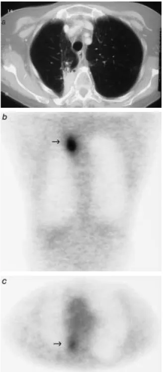 Fig. 1. ± Discordance between computed tomography (CT) and posi- posi-tron emission tomography (PET) findings in a 74-yr-old female with a recurrent tumour observed 1 yr post-treatment