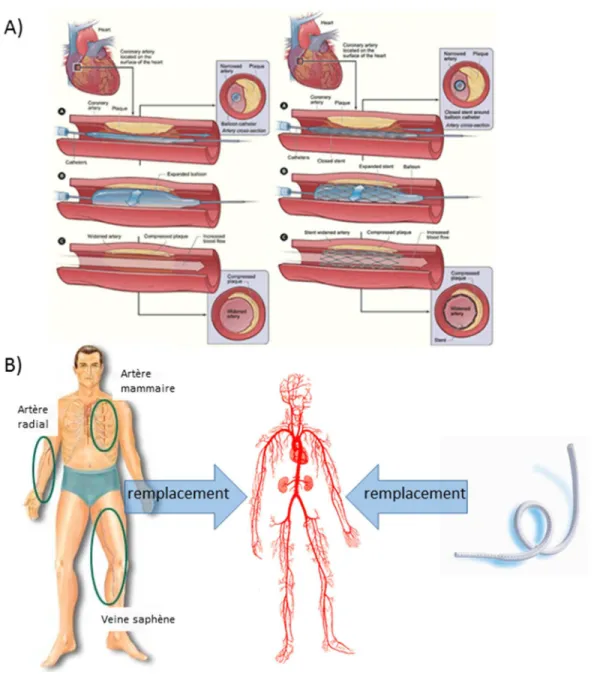 Figure 2: Les traitements invasifs de l’athérosclérose. Traitement par angioplastie avec ou sans  stent (B) et traitement par greffe autologue ou synthétique (C) [18-22]