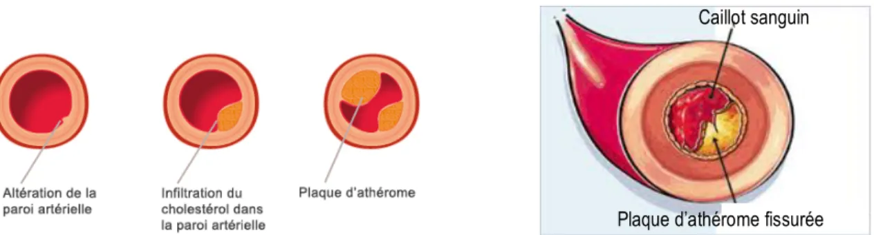Figure 1.1: Évolutions successives de la plaque d'athérome dans une artère (source image [2]) et occlusion de  l'artère par un caillot sanguin ( source image [3])