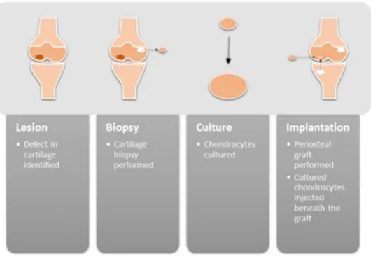 Fig. 1    A schematic demonstrat- demonstrat-ing the process of autologous  chondrocyte implantation
