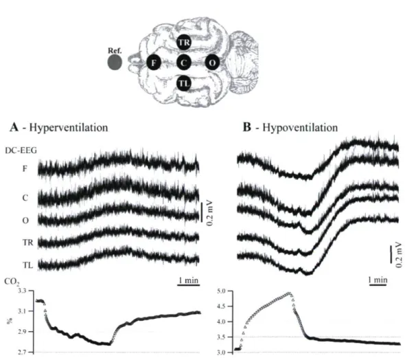Figure 1.Schéma du positionnement des électrodes sur le scalp et exemples des variations  du potentiel DC induites par l'hyperventilation (A) et l'hypoventilation (B) chez le chat  anesthésie à la kétamine-xylazine