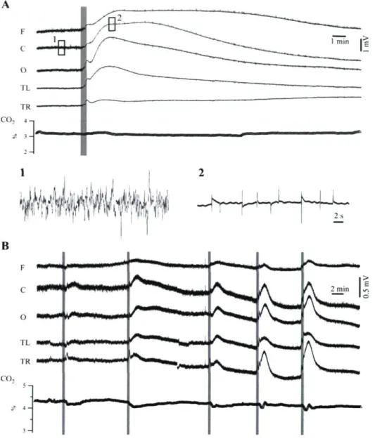 Figure 3. Déviation lente du potentiel DC de l'EEG par suite de l'injection unilatérale de  thiopental dans l'artère carotidienne gauche (barres grises)