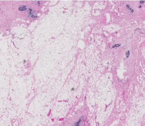 Figure  6.  Hematoxylin-eosin  staining  of  age-related  lobular  involution  of  the  breast  (magnification  5x)