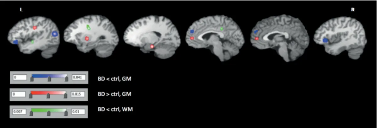 Figure 1. Gray and white matter significant differences in bipolar pateints  compared to controls