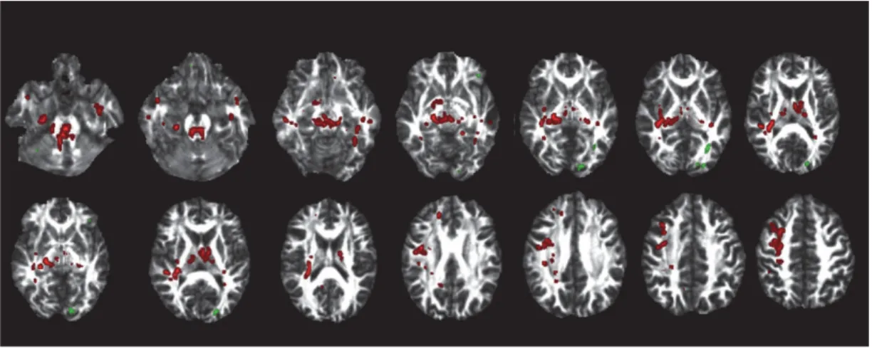 Figure 1. Significant differences of fractional anisotropy values between  unaffected bipolar patient’s relatives recruited in Québec and controls