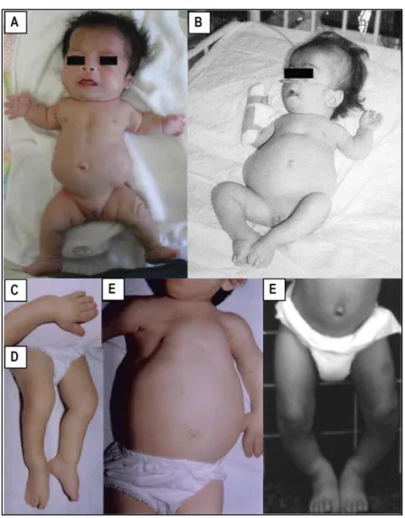Figure 12 : Phénotype clinique présenté par les patients opsismodysplasiques. A-B. Deux patients  à  la  naissance  présentant  une  micromélie  rhizomélique,  macrocéphalie,  front  saillant,  pont  nasal  déprimé, narines antéversées, implantation basses