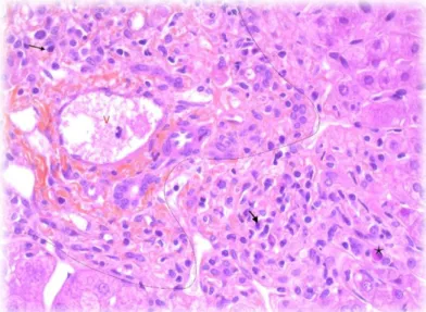 Figure 9 : Liver biopsy with sign of activity of AIH, HES staining .