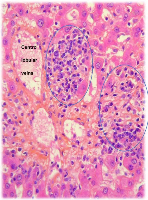 Figure 11 : Liver biopsy with sign of activity of AIH, HES staining : lymphoplasmocytic infiltration crossing the  bordering lamina, with apoptotic body .