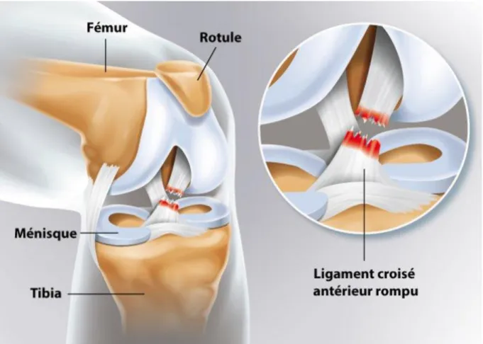 Figure 2 : Schématisation de la rupture du ligament croisé antérieur [4] 