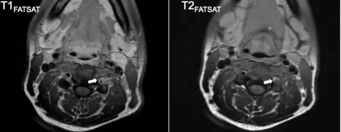 Figure 3: dissection vertébrale gauche à J9 d’une CCT, avec diagnostic de SVCR,  ayant eu une imagerie initiale des troncs supra-aortiques normale, chez une  femme de 38 ans ayant consommé du speed