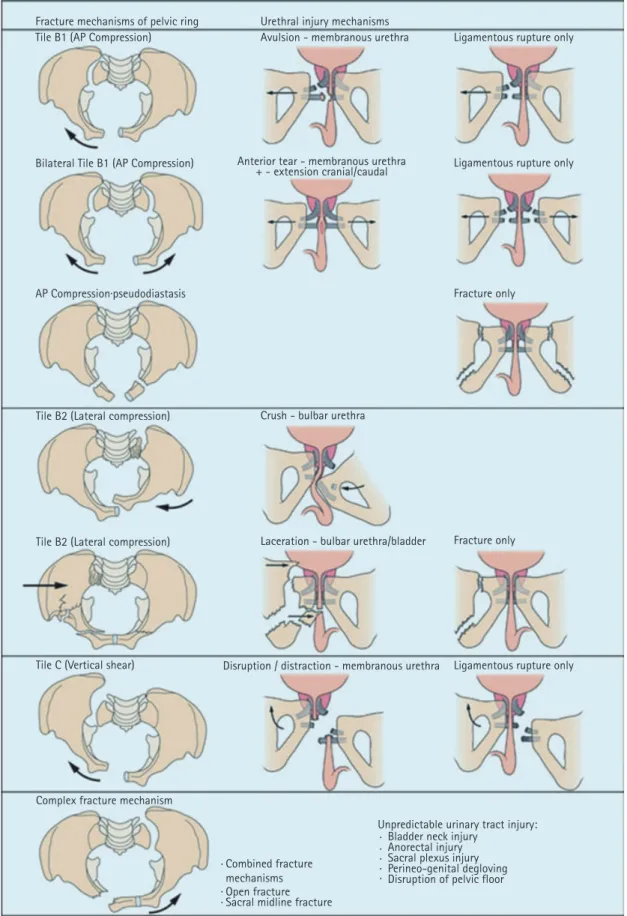Figure 1. Mécanismes de lésions urétrales en fonction du type de fracture du bassin (3)  