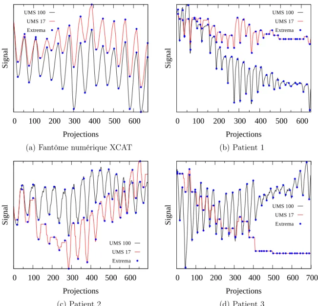 Figure 2.2 – Signaux respiratoires directement extraits de l’image AS pour un fantôme numérique et des scans de trois patients différents, pour un paramètre UMS de 17 ou de 100 pixels et avec comparaison aux extrema détectés manuellement