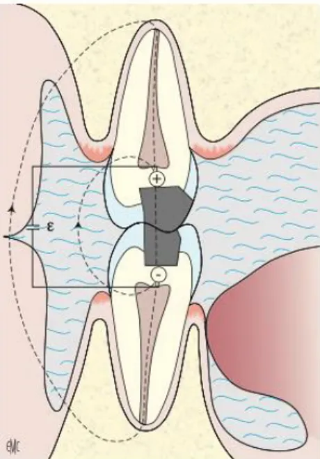 Figure 10 : Schéma de deux restaurations dentaires entrant en contact par intermittence 