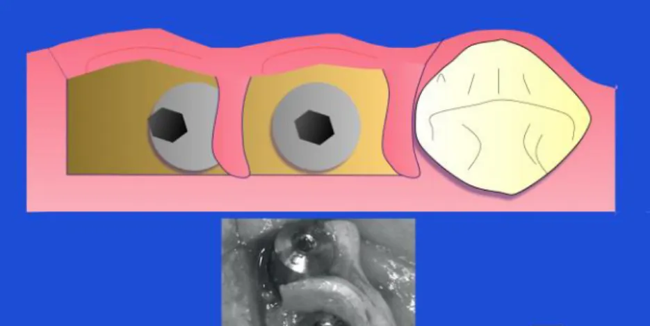 Figure 9 : Image d’un implant Nobel Activ (Source: SAPO IMPLANT) 