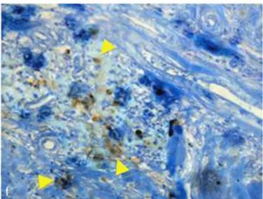 Figure 9 : Analyse histologique des débris dus à l’implantoplastie 