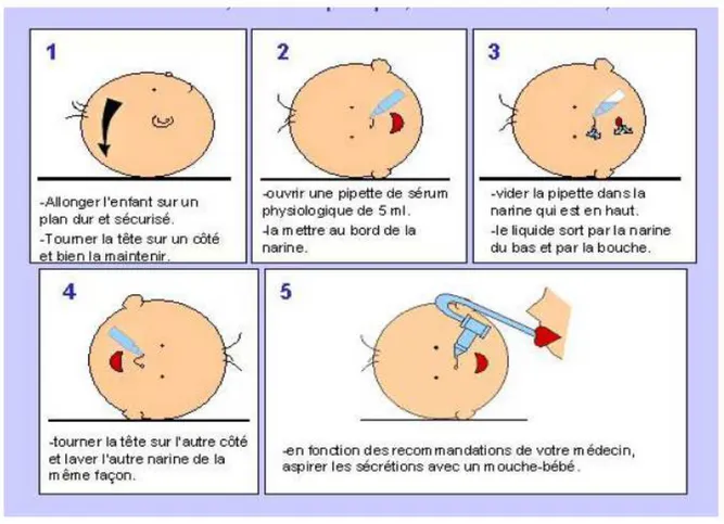 Figure 7 - Modalités pour la DRP.