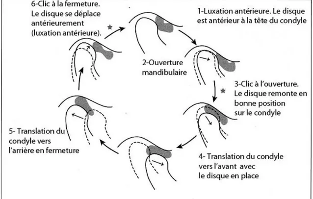 Figure 2 : Schéma d'un déplacement discal réductible lors de l'ouverture mandibulaire  (Okeson, 1998) 